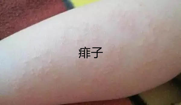 一张图教你区别湿疹和痱子