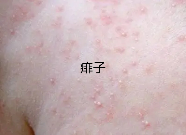 一张图教你区别湿疹和痱子